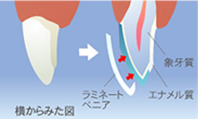 ラミネートべニア｜釧路市新橋大通沿い　よしもと歯科・矯正