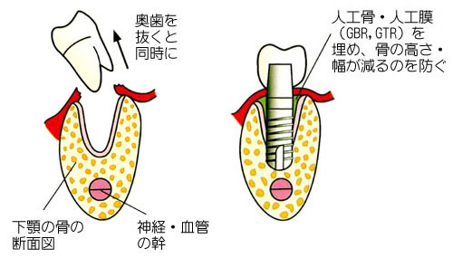 抜歯即時法｜釧路市新橋大通沿い　よしもと歯科・矯正