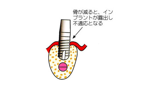 抜歯後待機法｜釧路市新橋大通沿い　よしもと歯科・矯正