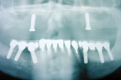 下顎両側インプラント レントゲン図｜釧路市新橋大通沿い　よしもと歯科・矯正
