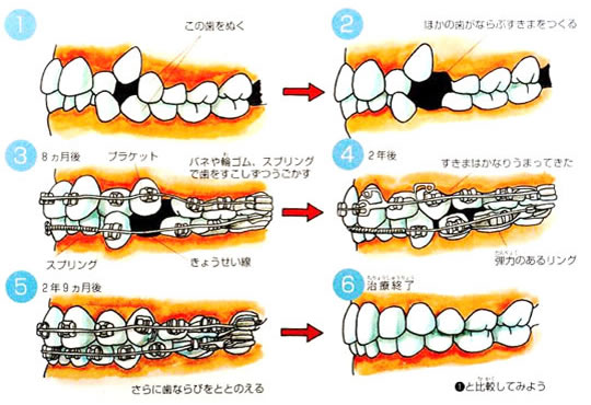 マルチブラケット法｜釧路市新橋大通沿い　よしもと歯科・矯正