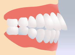 上顎前突｜釧路市新橋大通沿い　よしもと歯科・矯正