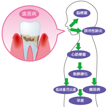 歯周病と全身疾患｜釧路市新橋大通沿い　よしもと歯科・矯正